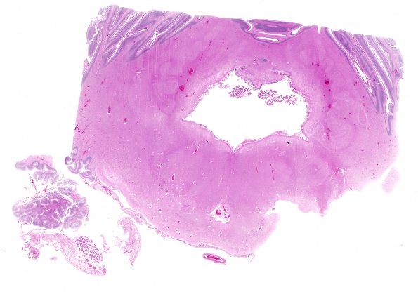 3C2 Hydrocephalus after IVH (Case 3) H&E 4A