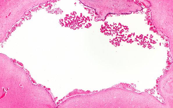 3C3 Hydrocephalus after IVH (Case 3) N5 H&E 2X