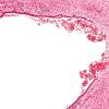 3C4 Hydrocephalus after IVH (Case 3) H&E 2B (Pons ventricle)