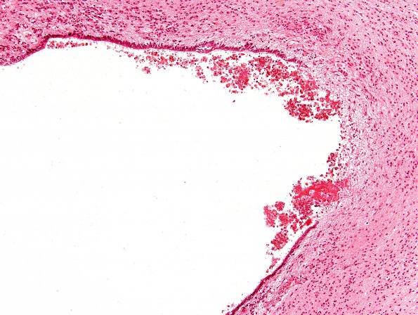 3C4 Hydrocephalus after IVH (Case 3) H&E 2B (Pons ventricle)