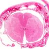 3D1 Hydrocephalus after IVH (Case 3) N6 H&E 2X copy