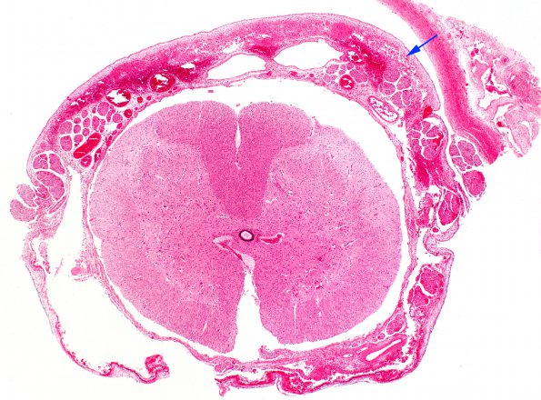 3D1 Hydrocephalus after IVH (Case 3) N6 H&E 2X copy