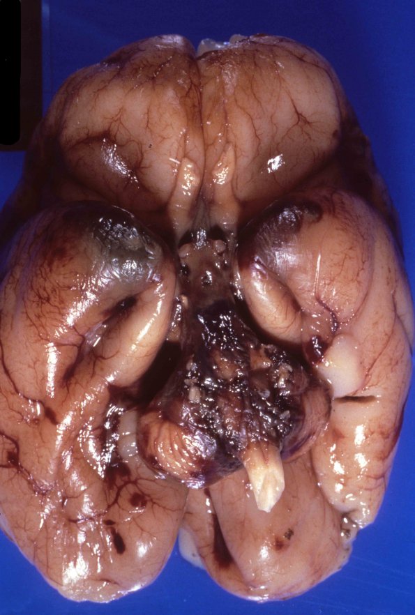 4A1 Hydrocephalus after IVH (Case 4) 5