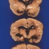 4A3 Hydrocephalus after IVH (Case 4) 4