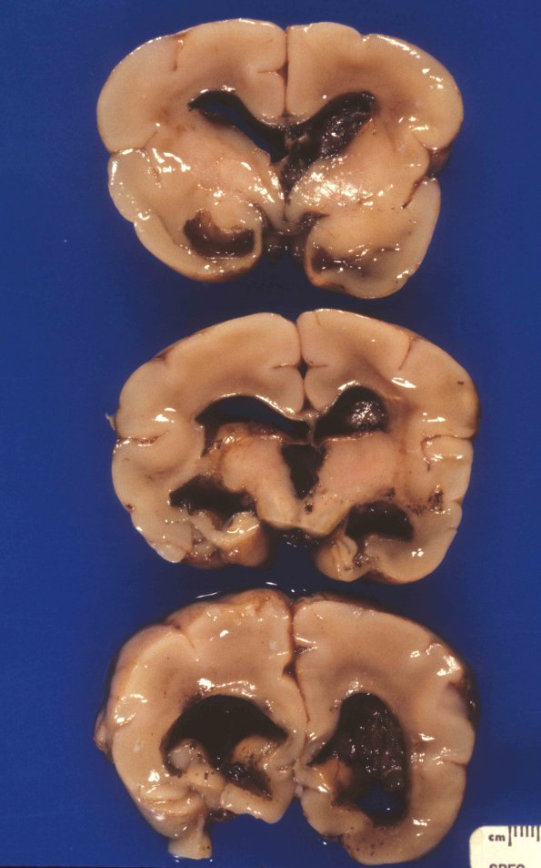 4A3 Hydrocephalus after IVH (Case 4) 4