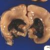 4A4 Hydrocephalus after IVH (Case 4) 2