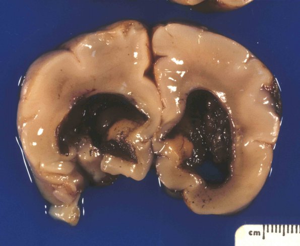 4A4 Hydrocephalus after IVH (Case 4) 2