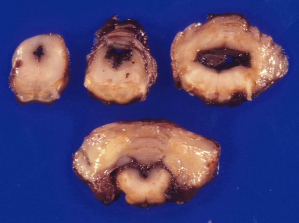 4A5 IVH & 2ndary HC, 3 wks (Case 4) 1