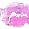 4B1 Hydrocephalus IVH (Case 4) F H&E WM copy