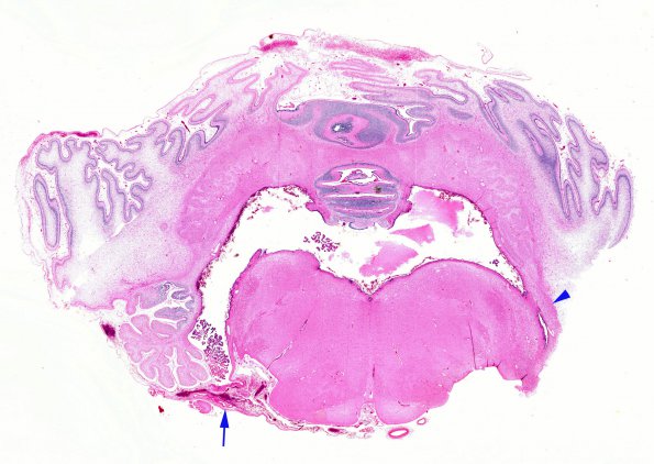 4B1 Hydrocephalus IVH (Case 4) F H&E WM copy