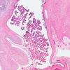 4B2 Hydrocephalus IVH (Case 4) F H&E 3