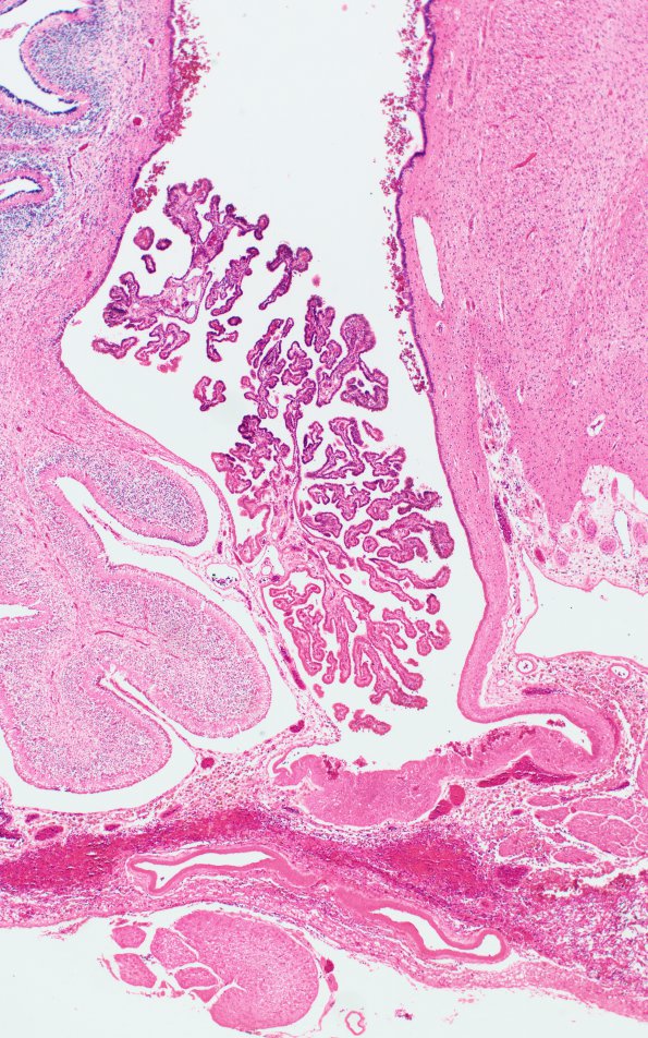 4B2 Hydrocephalus IVH (Case 4) F H&E 3