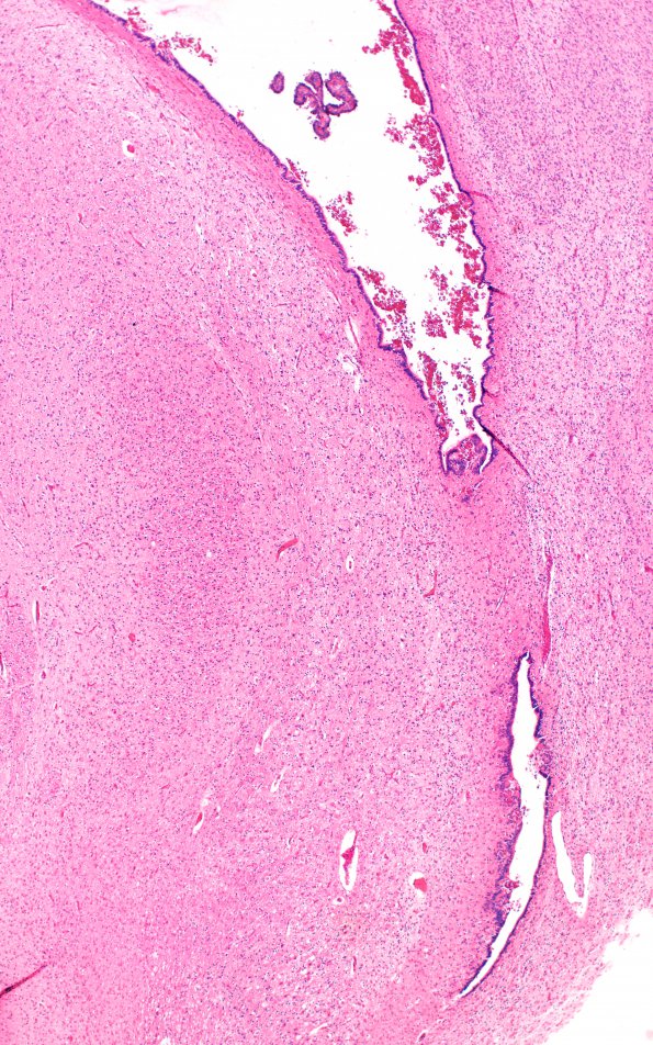 4B4 Hydrocephalus IVH (Case 4) F H&E 1