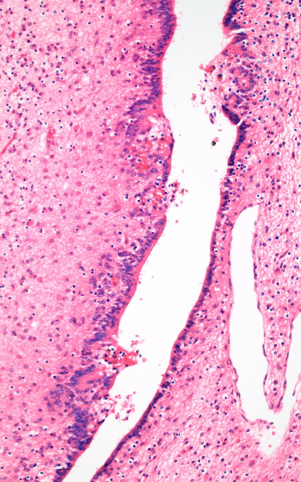 4B5 Hydrocephalus IVH (Case 4) F H&E 20X