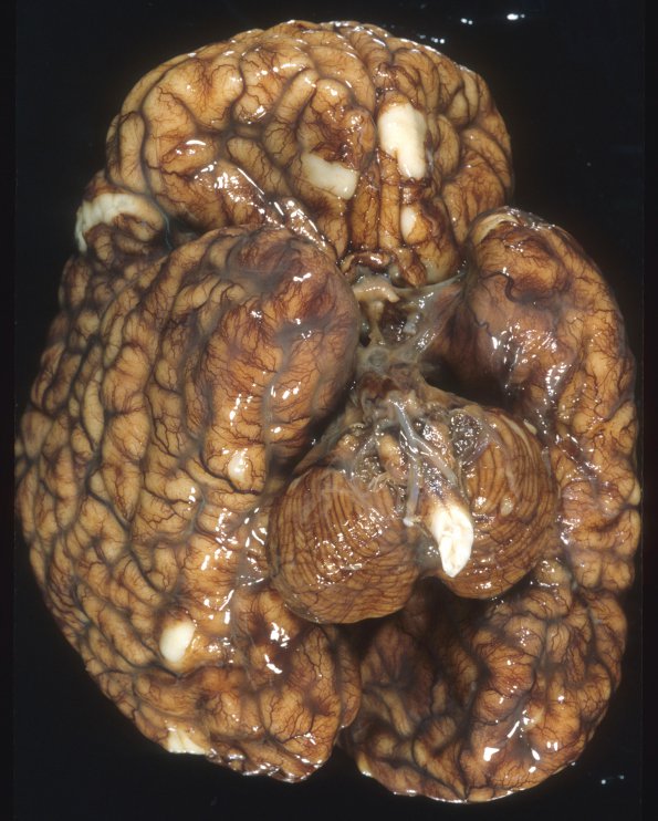 5A1 Hydrocephalus after IVH (Case 5) A13