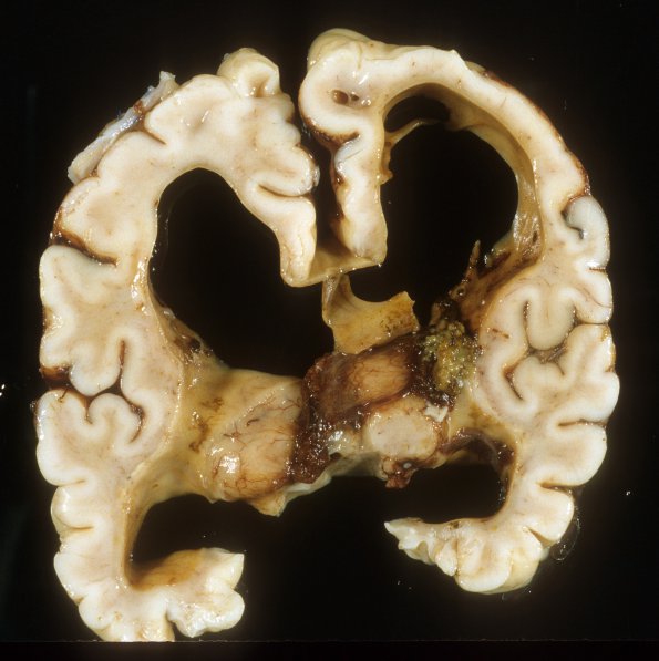 5A2 Hydrocephalus after IVH (Case 5) A14