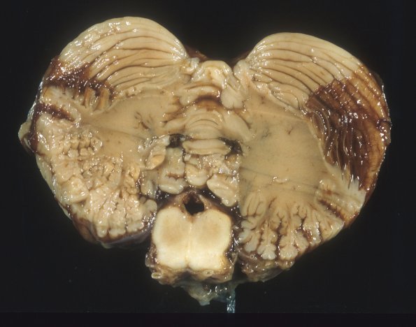 5A3 Hydrocephalus after IVH (Case 5) A12