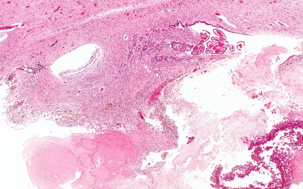 5B1 Hydrocephalus after IVH (Case 5) N11 4X