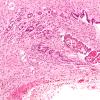 5B2 Hydrocephalus after IVH (Case 5) N11 10X 2