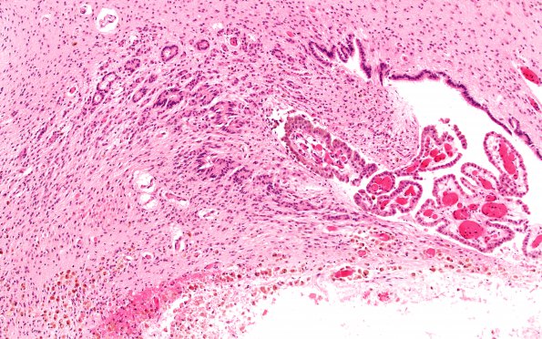 5B2 Hydrocephalus after IVH (Case 5) N11 10X 2