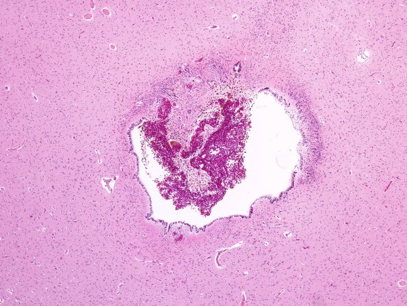 5B3 Hydrocephalus after IVH (Case 5) A11.jpg