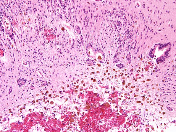 5B4 Hydrocephalus after IVH (Case 5) A10