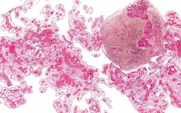 5B5 Hydrocephalus after IVH (Case 5) N11 4X 2