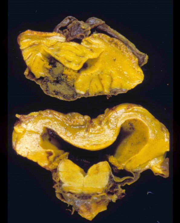 6A1 Hydrocephalus after IVH (Case 6) 2