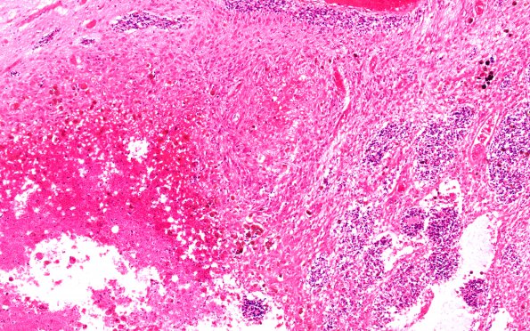 6B2 Hydrocephalus after IVH (Case 6) N2B H&E 20X 2