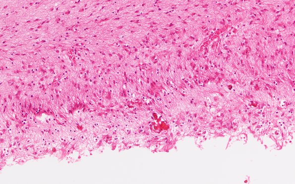 6B4 Hydrocephalus after IVH (Case 6) N5 H&E 20X