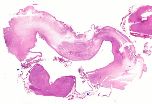 6C1 Hydrocephalus after IVH (Case 6) N8 H&E copy