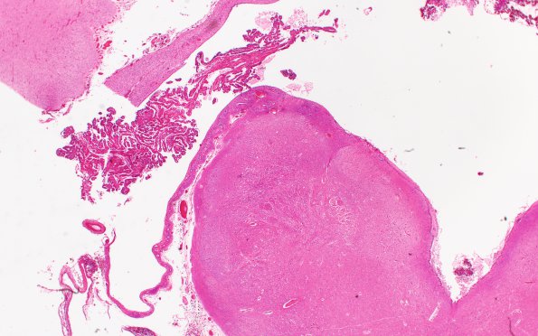 6C2 Hydrocephalus after IVH (Case 6) N8 H&E 2X