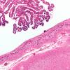 6C3 Hydrocephalus after IVH (Case 6) N8 H&E 10X