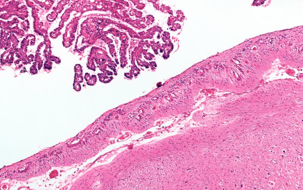 6C3 Hydrocephalus after IVH (Case 6) N8 H&E 10X