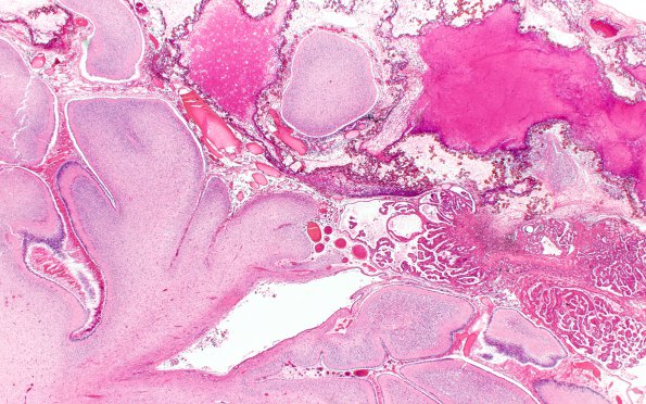 6C4 Hydrocephalus after IVH (Case 6) N9 H&E 2X