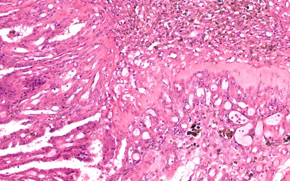 6C5 Hydrocephalus after IVH (Case 6) N9 H&E 20X