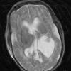 7A1 Hydrocephalus IVH (Case 7) T2 - Copy