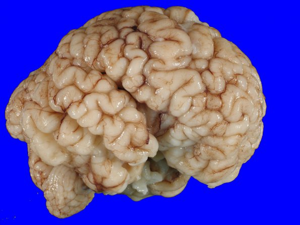 7B1 Hydrocephalus after IVH (Case 7) _4