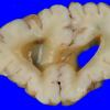 7B2 Hydrocephalus after IVH (Case 7) _5