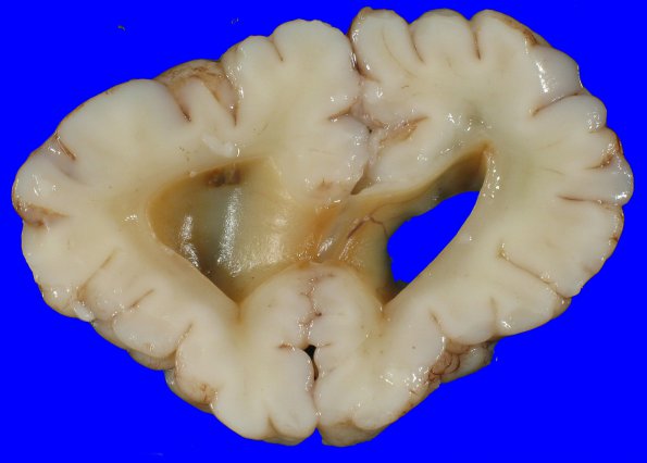 7B2 Hydrocephalus after IVH (Case 7) _5