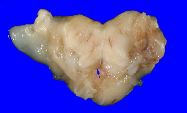 7B6 Hydrocephalus after IVH (Case 7) _14 copy