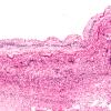 7C2 Hydrocephalus after IVH (Case 7) N11 10X 1