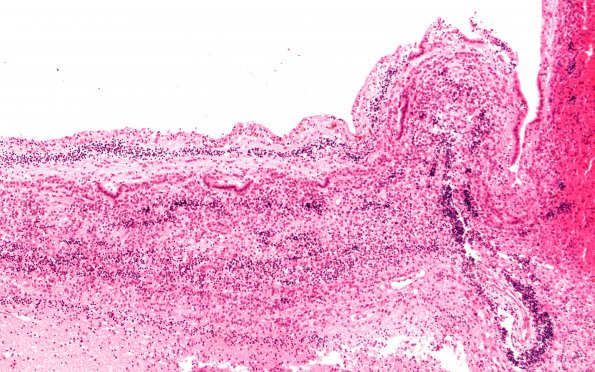 7C2 Hydrocephalus after IVH (Case 7) N11 10X 1