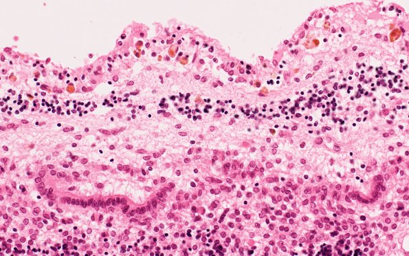 7C3 Hydrocephalus after IVH (Case 7) N11 40X 1