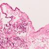 7C4 Hydrocephalus after IVH (Case 7) N3 10X 1