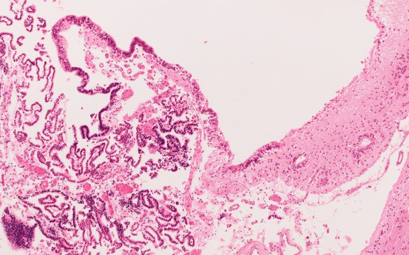 7C4 Hydrocephalus after IVH (Case 7) N3 10X 1