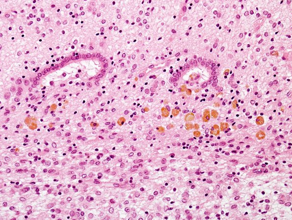 7C5 Hydrocephalus after IVH (Case 7) H&E 3