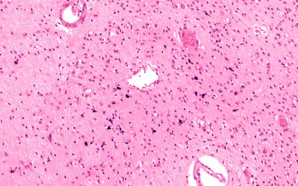 7C6 Hydrocephalus after IVH (Case 7) N4 20X 1