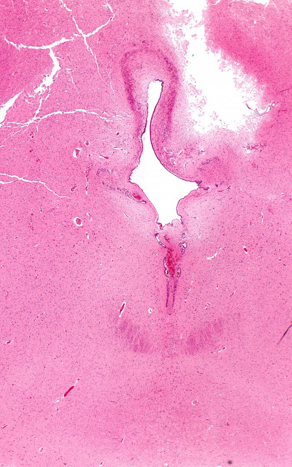 7D1 Hydrocephalus after IVH (Case 7) N6 2X 1