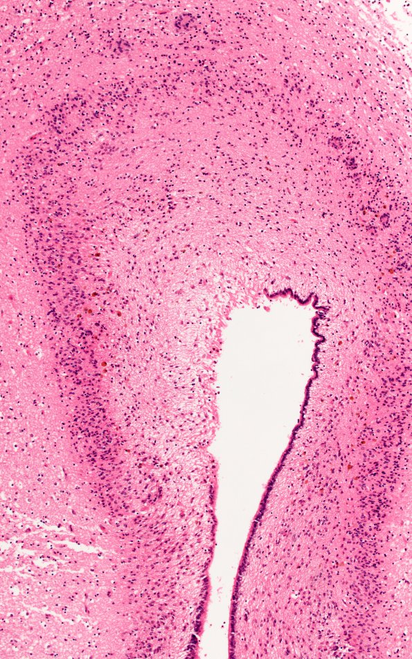 7D2 Hydrocephalus after IVH (Case 7) N6 20X 1